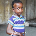 mercy-ships-patient-stories-aliou-plastics-hero-image
