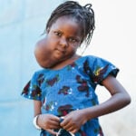 mercy-ships-patient-stories-houleye-maxfax-hero-image