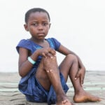 mercy-ships-patient-stories-maeva-plastics-hero-image