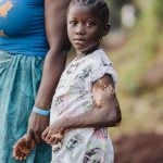 Burn scars kept Musu's future out of reach. Hope changed everything.