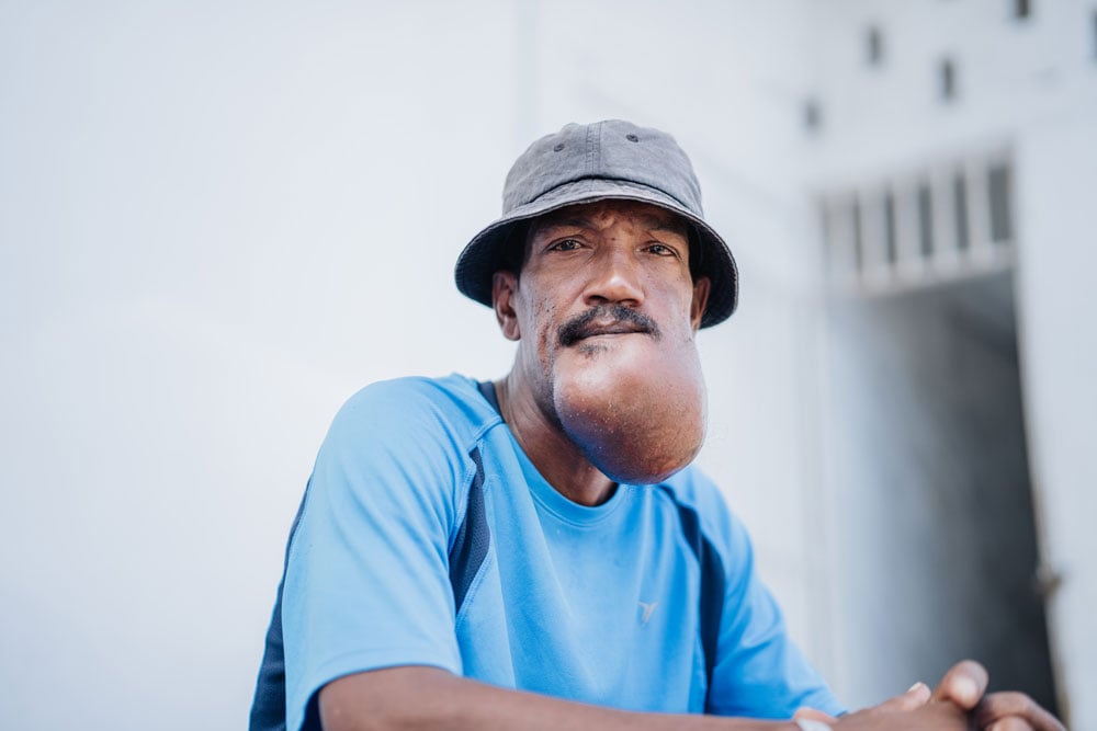 A tumor began growing on Thierry's jaw when he was 25. Now 41, hope is on the horizon.